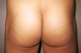 buttocks