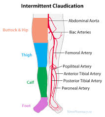 claudication