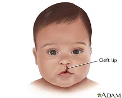 cleft