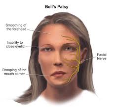 palsy