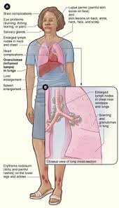 sarcoid