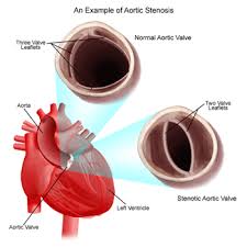 stenosis