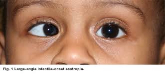 strabismus